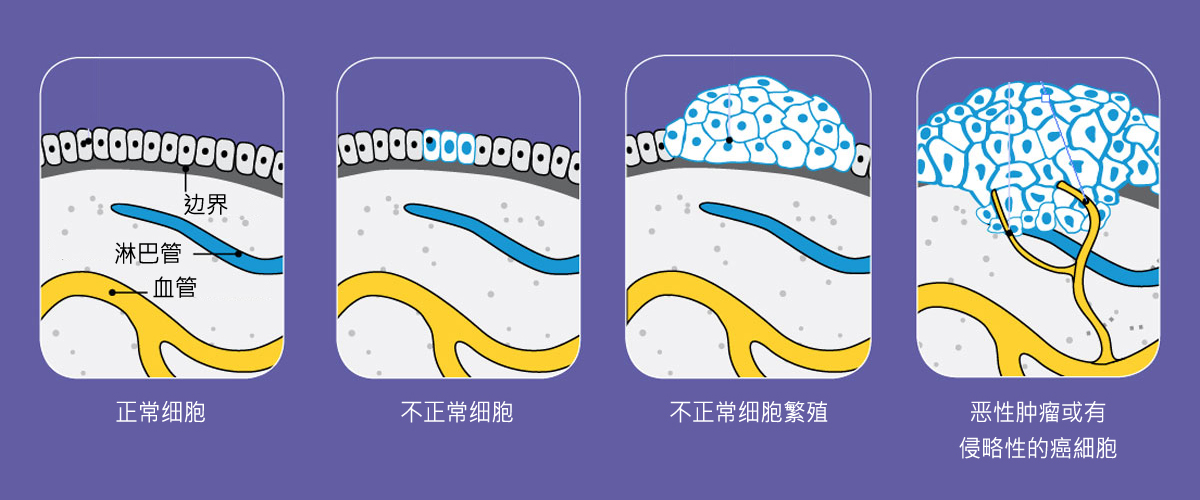 早期癌癥篩查